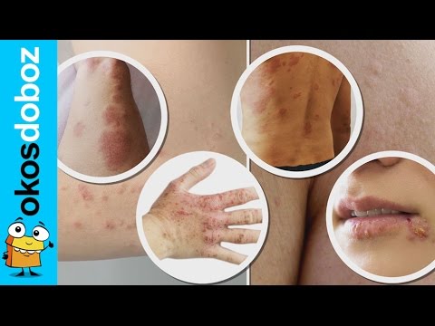 Huile essentielle myrrhe psoriasis