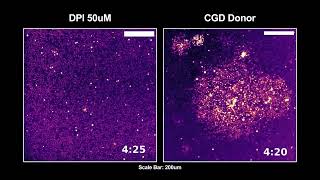 Disorganized Calcium waves in patient neutrophils during swarming