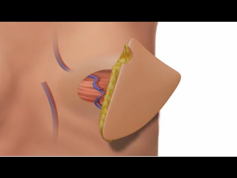 Delayed Breast Reconstruction