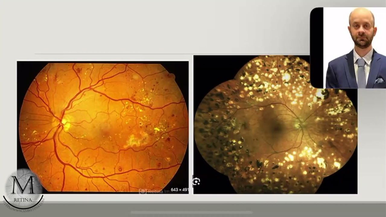 Diabetic Retinopathy Management