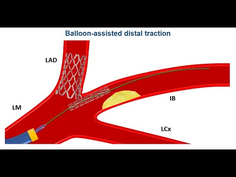 Intracoronary stent loss  #cardiology #cardiologyfellow #unam #anahuac  #anatomy #complication