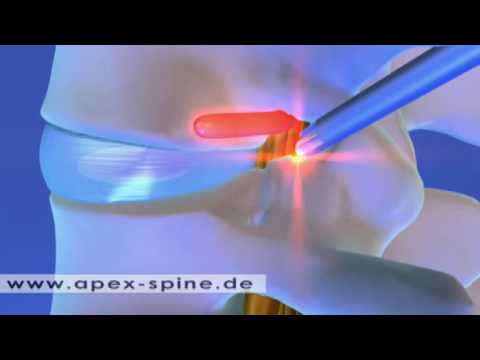 Ernährung bei Erkrankungen der Gelenke Der Schmerz des Gebens auf das Bein und Fuß taub zurück