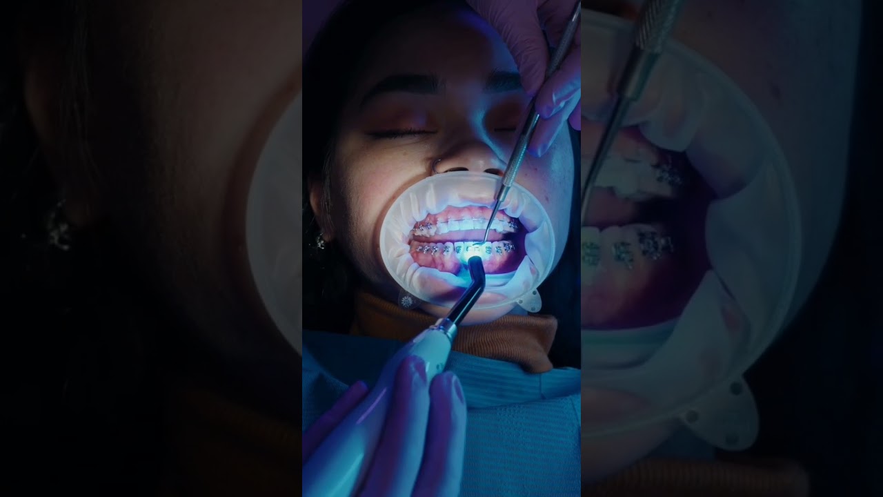 orthodontc bracket fixing procedure #short