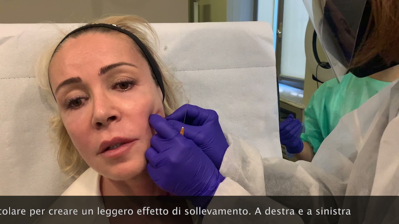 Watch Now Alleggerire la piega della marionetta con i fillers. Alleggerire la piega della marionetta con i fillers.