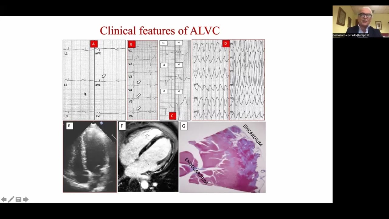 Low QRS voltages in athletes; What do they mean - Professor  Domenico Corrado