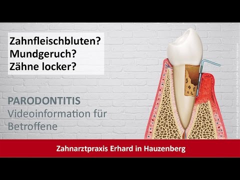 Parodontitis-Behandlung Zahnarzt Hauzenberg - Dres. Erhard