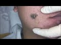 Popping Cyst on Face