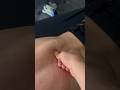 HUGE KNOT OUCH Lowerback Adhesion Pain Knots