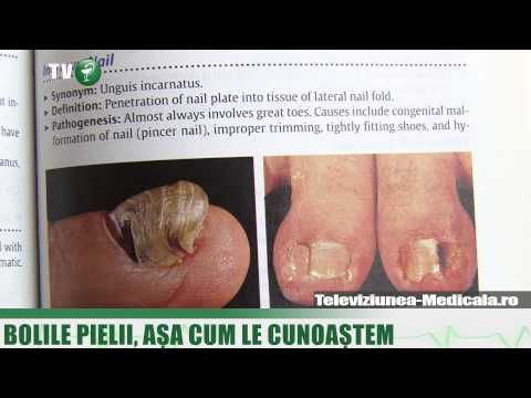 Antibiotice tratament ciuperca unghiilor de la picioare