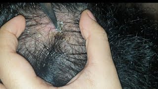 best patch of dandruff scab found so far - satisfying - watch till end - scab pick using knife -asmr