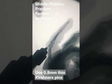 Technique for fixation of Middle phalanx shaft fracture