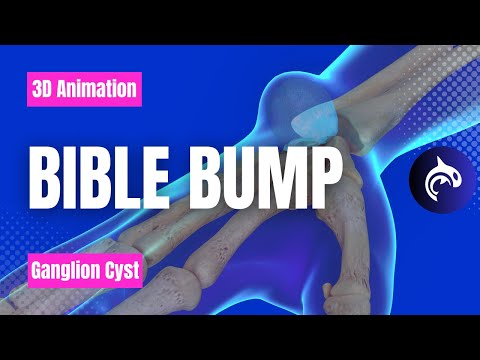 Trigger Finger Condition and Release 3D Animation No Narration