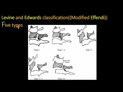 Hangman’s fracture