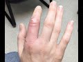 Brutus Cat Bite Cellulitis Ouch