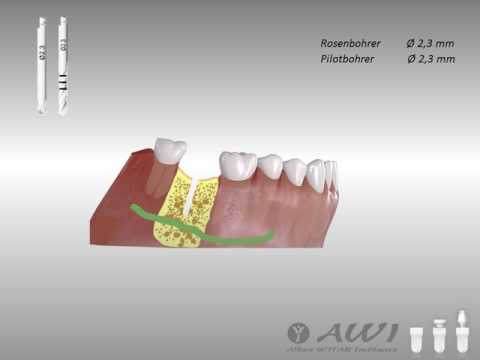 AWI Implants - die metallfreien Implantate aus Hochleistungskeramik