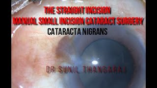 SICS (straight incision)  black cataract