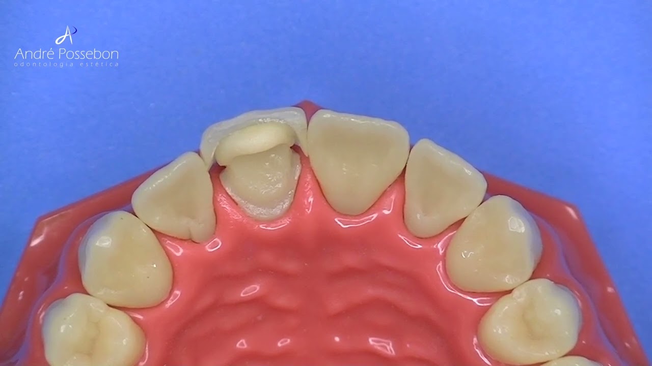 🎯 Dica #34 - Provisorio com faceta de dente de estoque.
