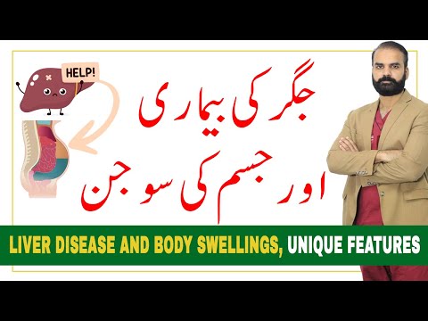 Liver Diseases and Body Swelling - Causes & Symptoms - Urdu/Hindi