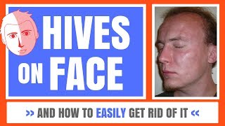 Hives On Face - And How To Easily Get Rid Of It