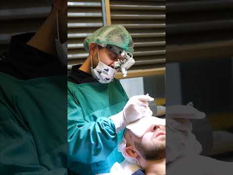 HAIR TRANSPLANT DAY OF A PATIENT