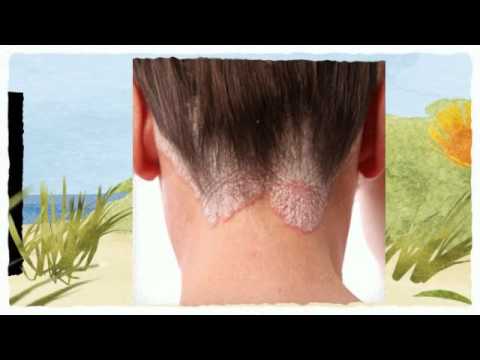Unguento da una mummia da psoriasi Curare la psoriasi in Astana