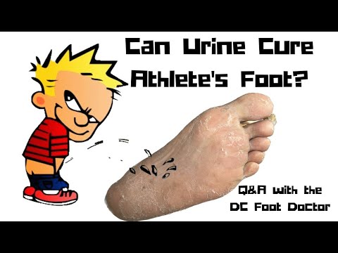 Can Urine Cure Athlete's Foot?