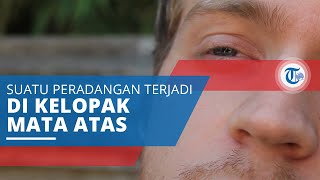 Blefaritis, Sebuah Peradangan yang Terjadi di Mata, Khususnya di Daerah Kelopak Mata Bagian Atas