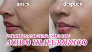Relleno con Ácido Hialuronico en Surco Nasogeniano (arruga estática) - Dr. Sergio Zerpa