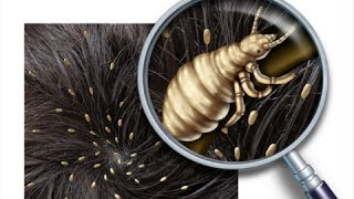 How to Get Rid of Head Lice Fast