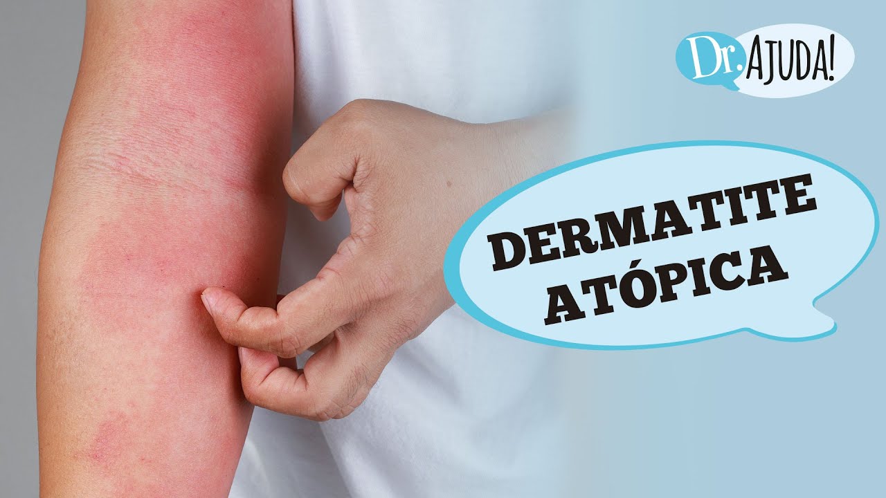 DERMATITE ATÓPICA: O QUE VOCÊ PRECISA SABER SOBRE ISSO?