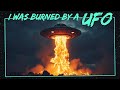 I Was Burned By A UFO