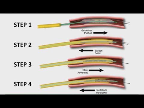 PCI of calcified left main – how to do it safely? PCR Round Table Webinar