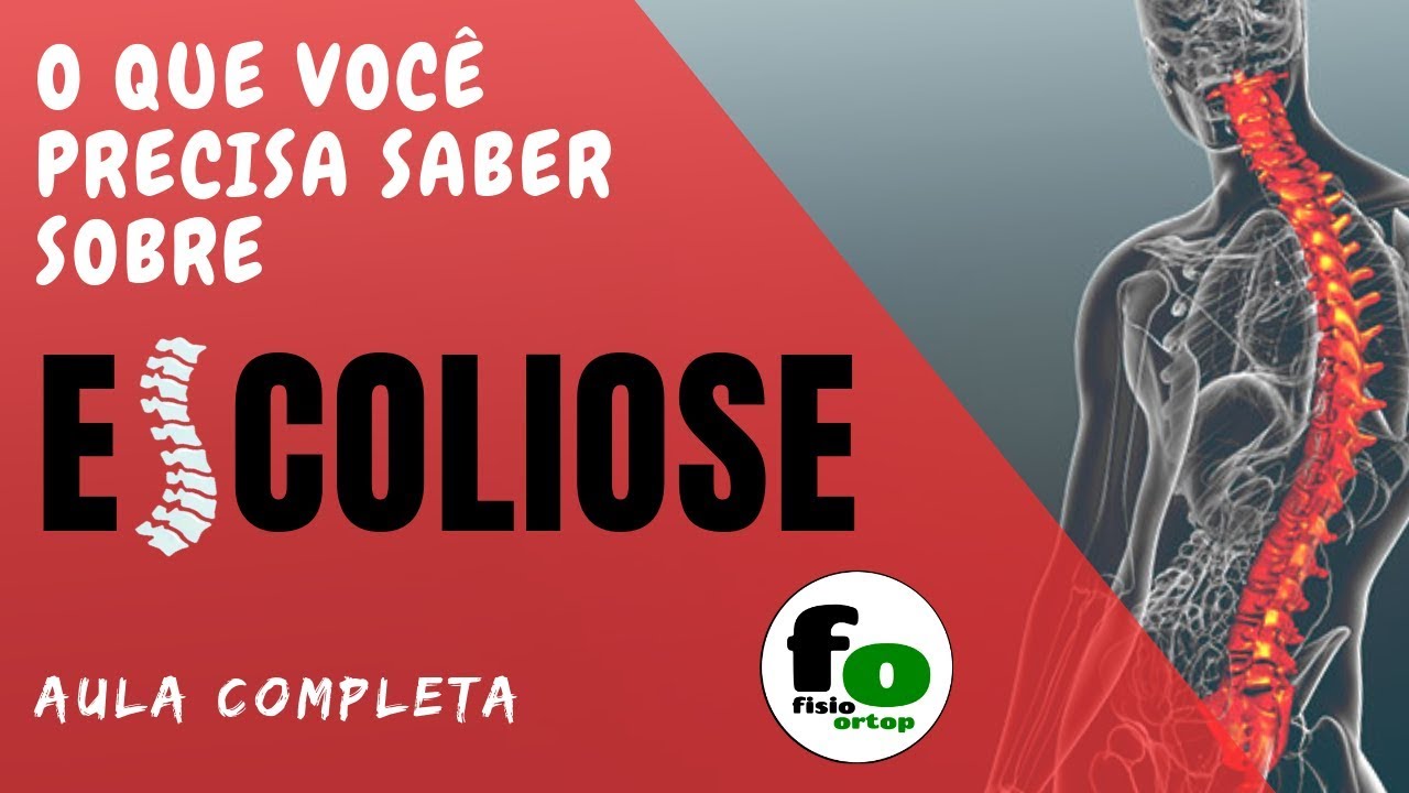 O que você precisa saber sobre Escoliose | Aula Completa