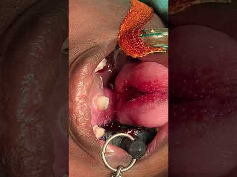 Tongue Flap For A Large Defect In The Upper Jaw - Surgical Video