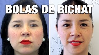 Bolas de Bichat Antes y Después | Clínicas Diego de León Madrid