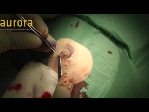 Unilateral Inverted Nipple Correction Surgery