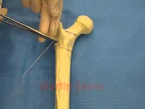 calcar crack dry bones