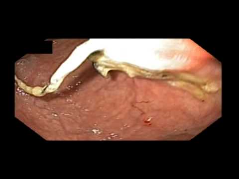 Prior Cyst Gastrostomy