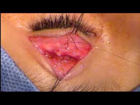 Resección aponeurótica (base tarso)