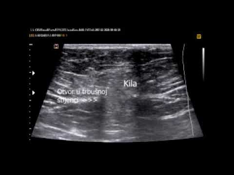 Kila trbušne stijenke  Poliklinika Kvarantan