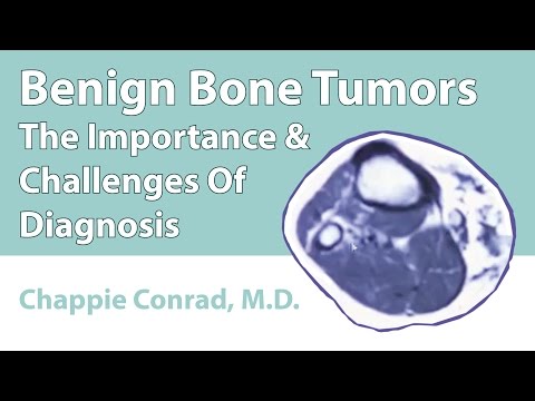Benign Bone Tumors (The Importance & Challenges Of Diagnosis)