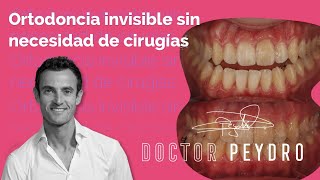 ¿Es posible corregir casos complejos de ortodoncia sin cirugía