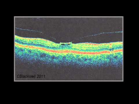 Vitreous And Trouble 2/3