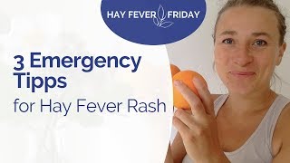 Relief Hay Fever Rash within 30 min - 3 Emergency Tips