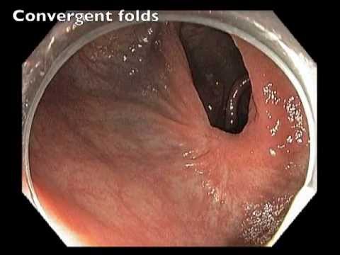 Transverse Colon - Failed Resection of Large Flat Lesion