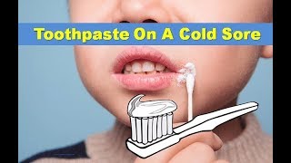 Toothpaste On Cold Sore: Does It Work? | home remedy for cold sore