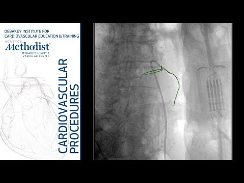 Inferior Mesenteric Artery Embolization (Lumsden, MD, Auyang, MD, Ponraj Chinnadurai)