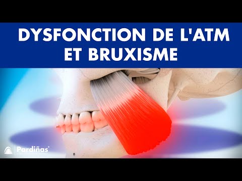 Dysfonction de l'articulation temporo mandibulaire et bruxisme ©
