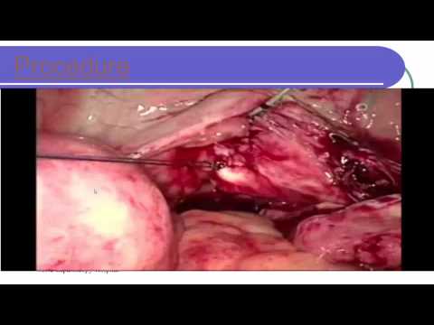 Cure de fistule vésico-vaginale par voie laparoscopique