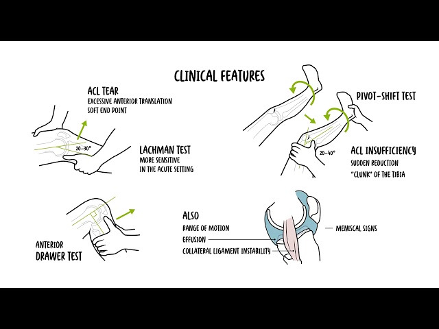 ACL Tear Explained: Causes, Symptoms, Diagnosis and Treatment
